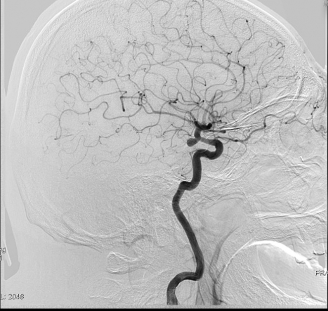 Beyin damarındaki tıkanıklıkta "stent" hayat kurtarıyor