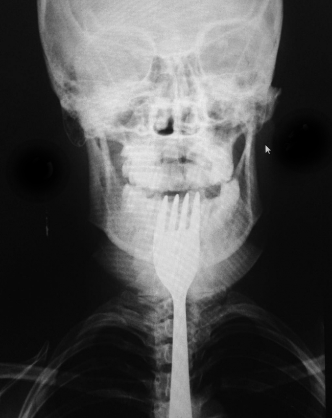 Dişini karıştırdığı çatal boğazına takıldı