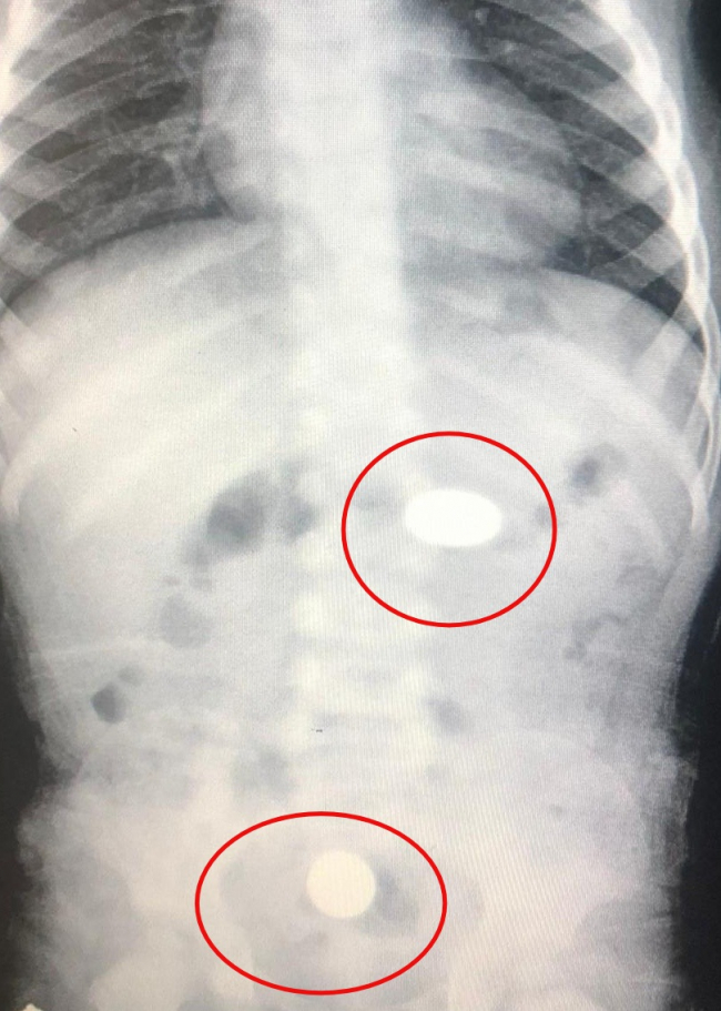 Madeni para yutan bebek hastanelik oldu