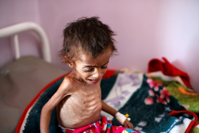 Yemen'de açlık hastalık ve savaşın gölgesinde yaşam mücadelesi