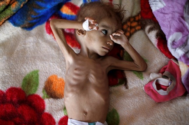 Yemen'de açlık hastalık ve savaşın gölgesinde yaşam mücadelesi