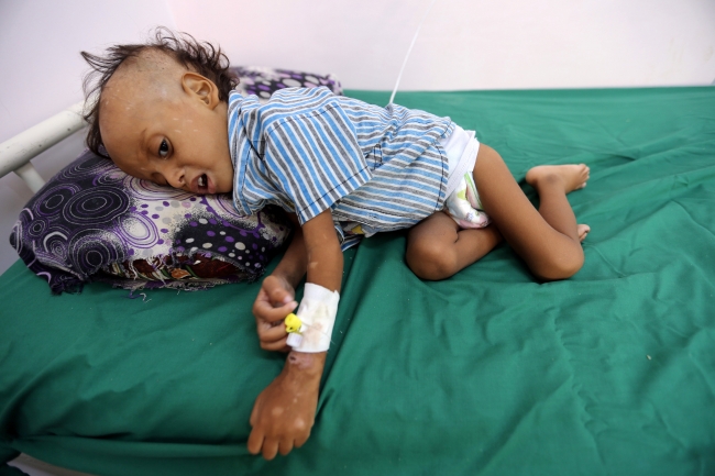 Yemen'de  8,6 milyon çocuk sudan da mahrum