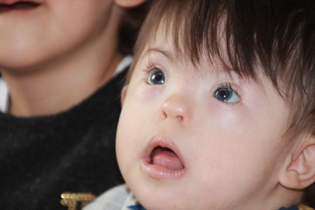 Down sendromlu Mert bebek duyabilmek için yardım bekliyor
