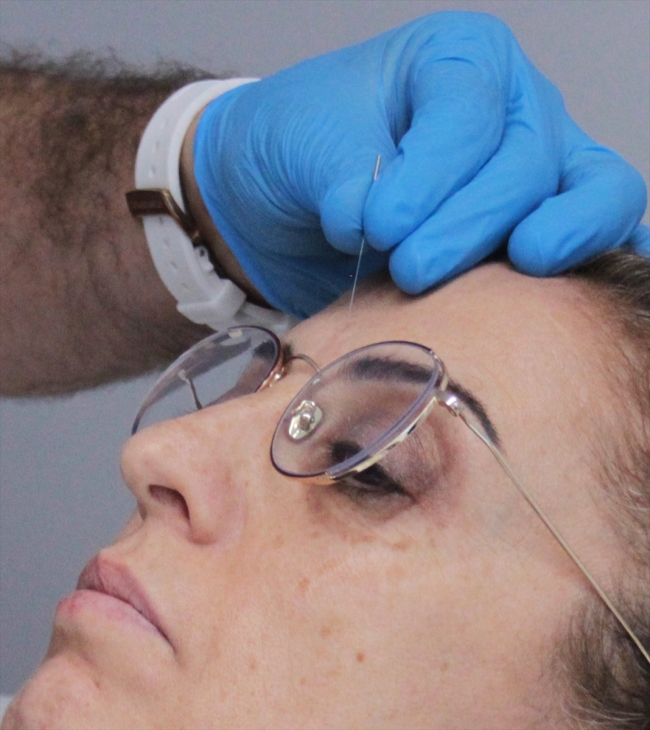 Alzheimer depresyona akupunktur freni