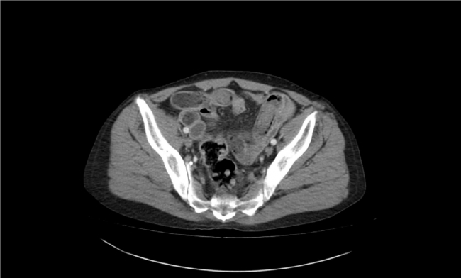 İran'dan Adana'ya midesindeki 775 gram eroinle gelmiş
