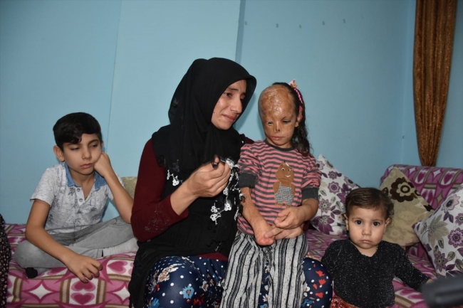 Bebekken yüzü yanan 5 yaşındaki Dilara ameliyat için yardım bekliyor