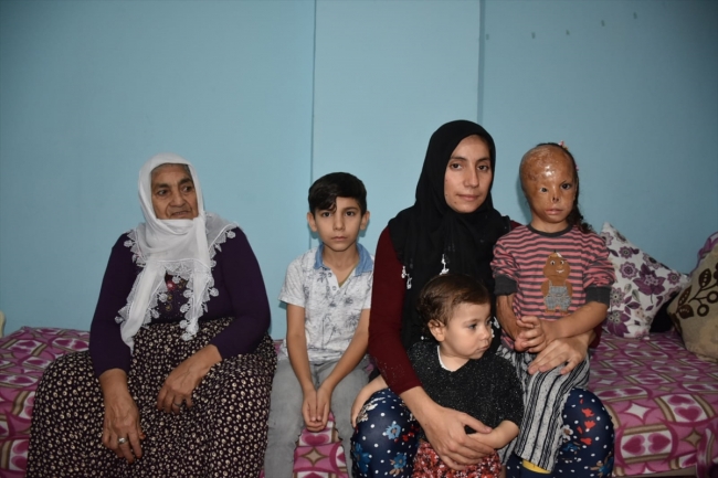Bebekken yüzü yanan 5 yaşındaki Dilara ameliyat için yardım bekliyor