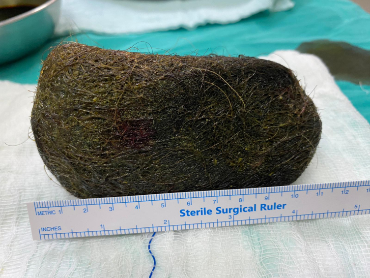 Osmaniye'de bir kadının midesinden 2 kilo saç çıktı