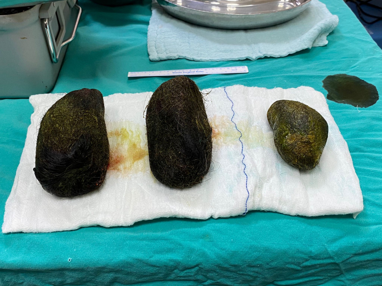 Osmaniye'de bir kadının midesinden 2 kilo saç çıktı