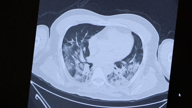 Prof. Dr. Şevket Özkaya: Ya yasaklarla yaşayacağız ya da aşı olacağız