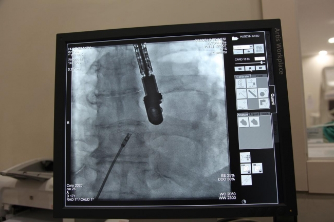 80 yaşına kadar kalbi delik yaşadı