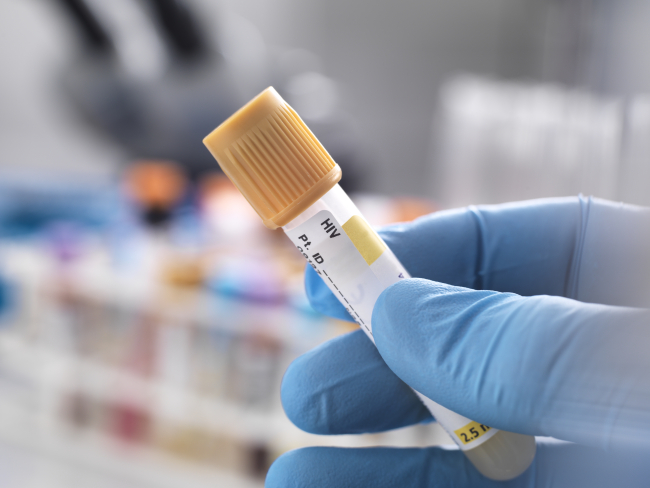 Bağışıklığın sinsi düşmanı: AIDS - Son Dakika Haberleri