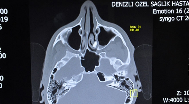 Burnundaki diş kökü 6 yıl sonra çıkarıldı