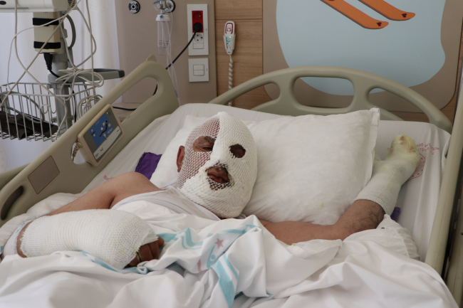 Tıkalı lavaboya kimyasal ürün döken adamın vücudu yandı