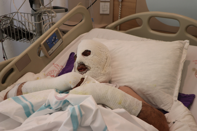 Tıkalı lavaboya kimyasal ürün döken adamın vücudu yandı