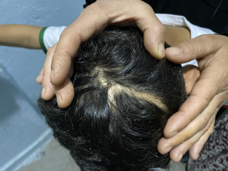 Köpek saldırısında yaralanan 8 yaşındaki Burak sokağa çıkmaya korkuyor