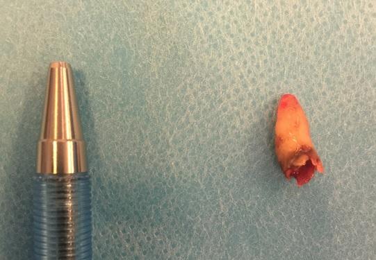 Danimarka'da bir kişinin burnunda diş çıktı