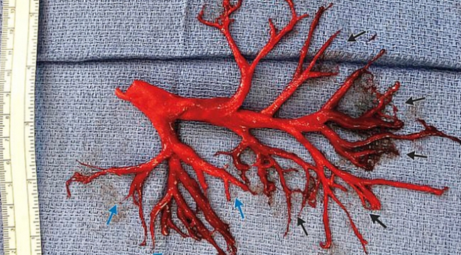 Öksürünce akciğeri fırlayan hasta hayatını kaybetti