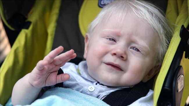 Dünya Albinizm Farkındalık Günü'nde 'beyaz melekler'in sorunları anlatılacak